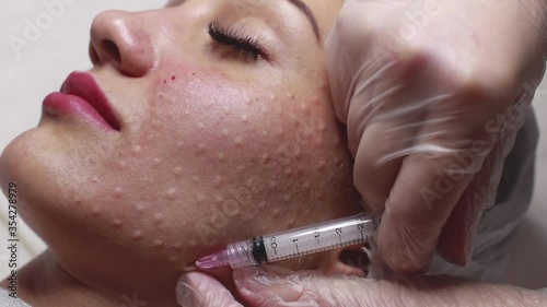 Face mesotherapy procedure in a beauty salon.
Beautician doctor makes injections into the skin of the face of a young beautiful woman.Mesotherapy, biorevitalization.Close-up. Selective focus. photo