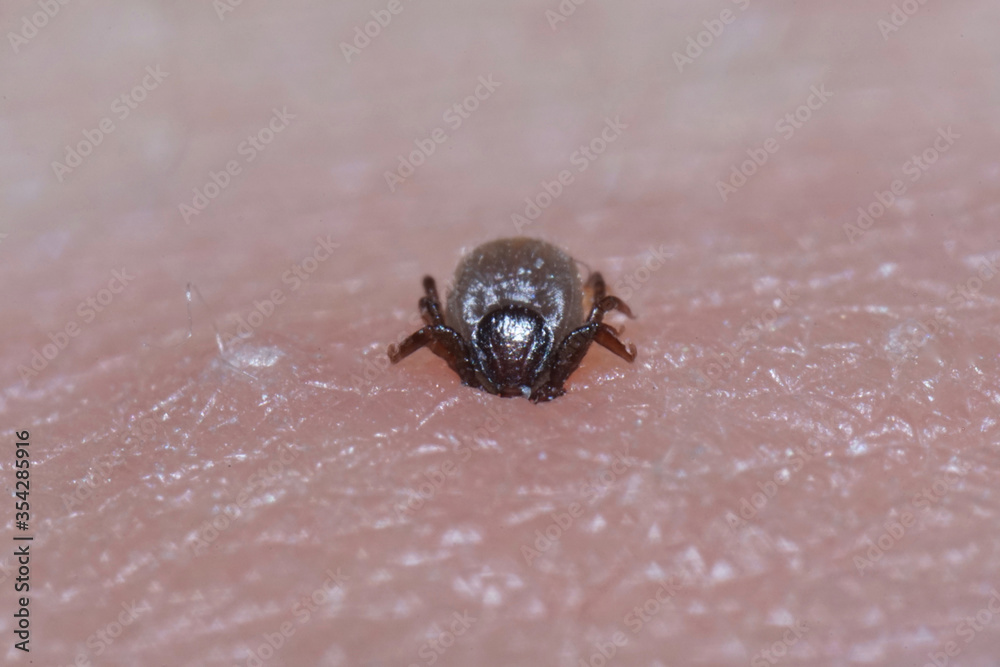Super close up of sucking Ixodes ricinus on human skin. Adults feed on large mammals such as sheep, cattle, dogs, deer, humans, and horses for 6–13 days, before dropping off. Super close up of sucking Ixodes ricinus on human skin. Adults feed on large mammals such as sheep, cattle, dogs, deer, humans, and horses for 6–13 days, before dropping off.