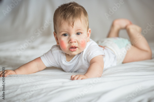 Wallpaper Mural Atopic dermatitis eczema in baby.Condition that causes the skin to become red,dry,sore,itchy and cracked.Atopic eczema most often affects face in children. Torontodigital.ca