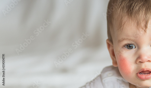 фотографія Atopic dermatitis eczema in baby
