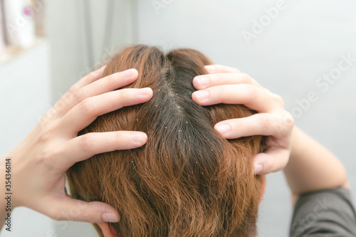 Dandruff and greasy hair on the head of a young female. Unhealthy head skin