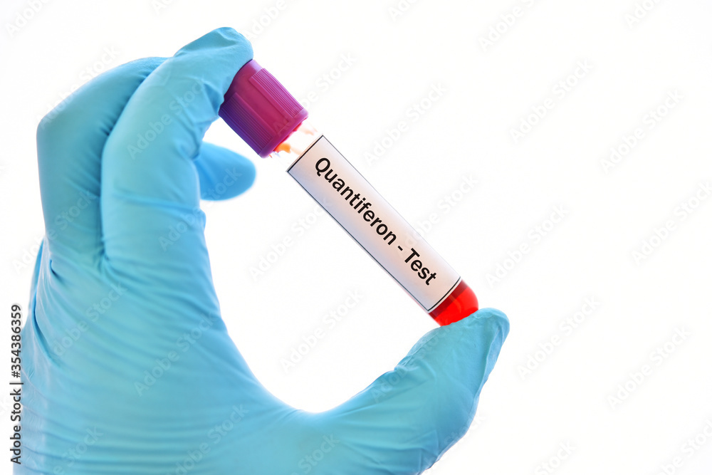 Fototapeta premium Test tube with blood sample for Quantiferon test, diagnosis for mycobacterium tuberculosis infection