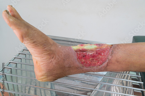 Close up of a senior leg with infected wound from accident. Medical concept. photo