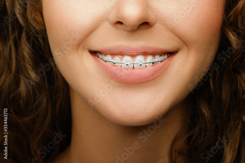 Closeup of orthodontic treatment for female