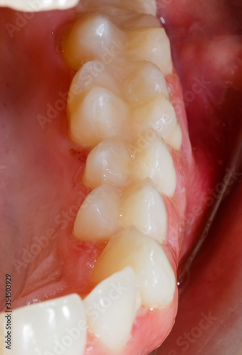 Human teeth after dental treatment