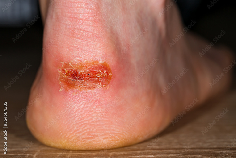 Fototapeta premium Painful injury on heel
