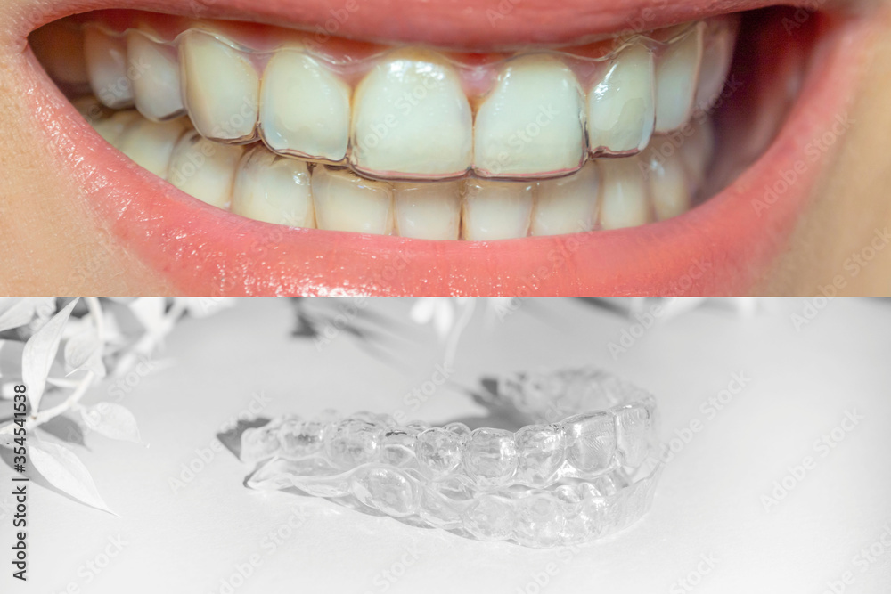 collage teeth with orthodontic braces, beautiful smile with transparent braces and individual aligners with white leaves, concept of mobile orthodontic appliance for dental correction.