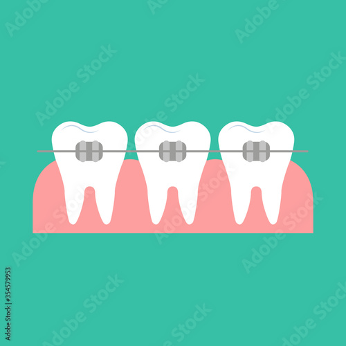 Teeth Braces - Vector Flat Illustration