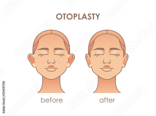 Otoplasty. Ear surgery. Vector illustration of female face before and after. Plastic surgery