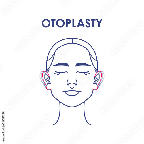 Otoplasty. Ear surgery. Vector illustration of female face. Plastic surgery