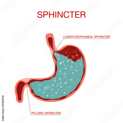 Pyloric sphincter of the stomach duodenum. Pylorus. Lower esophageal sphincter doesn’t relax. photo