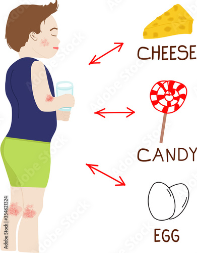 Children boy with dermatitis because of milk allergy. Allergy to cow s milk protein, egg, sweets, candies, cheese. Boy has red dots and skin irritation on his face, legs and hands. Food allergy.