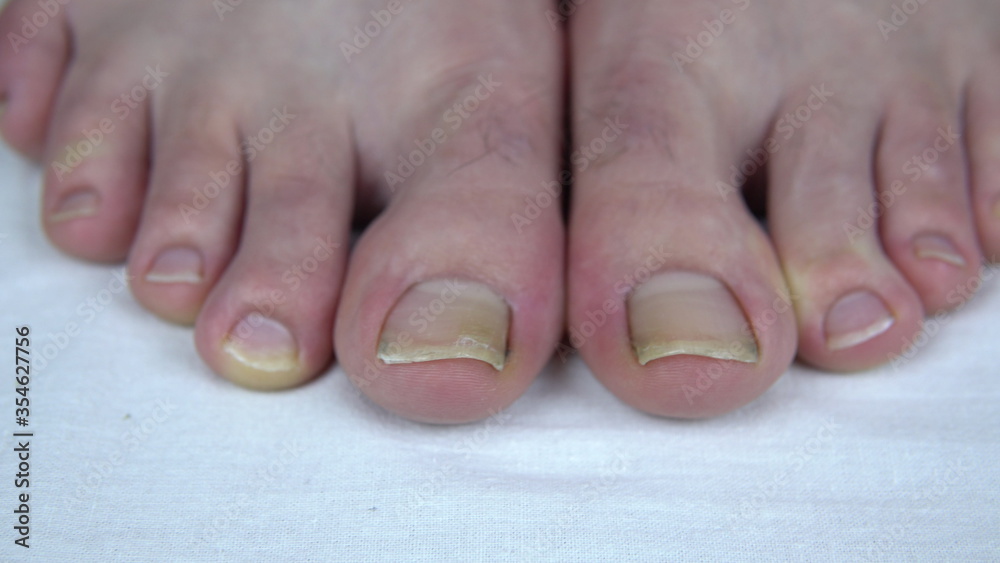 Large uncut toenails with fungus. The man has yellow toenails. Long did not cut your nails Large uncut toenails with fungus. The man has yellow toenails. Long did not cut your nails