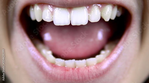 Young woman shows crooked teeth. The woman opened her mouth. Close-up.