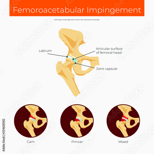 Femoroacetabular impingement cheme anatomy poster photo