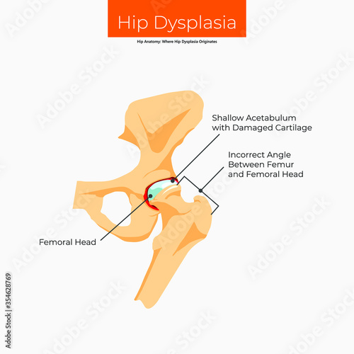 Hip Anatomy. Where Hip Dysplasia Originates