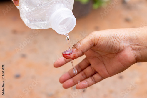 The saline solution is poured over the human finger with black nails, bruised with blood.