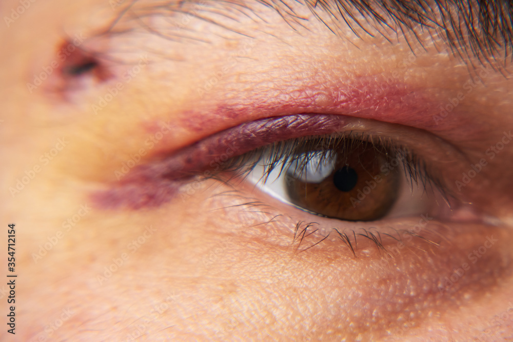Obraz premium close view of a black eye, man's face with a hematoma