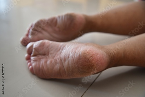 Broken skin under the feet