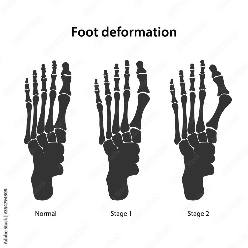 Valgus Deformity Of The Big Toe Healthy Foot And Stages Of Development