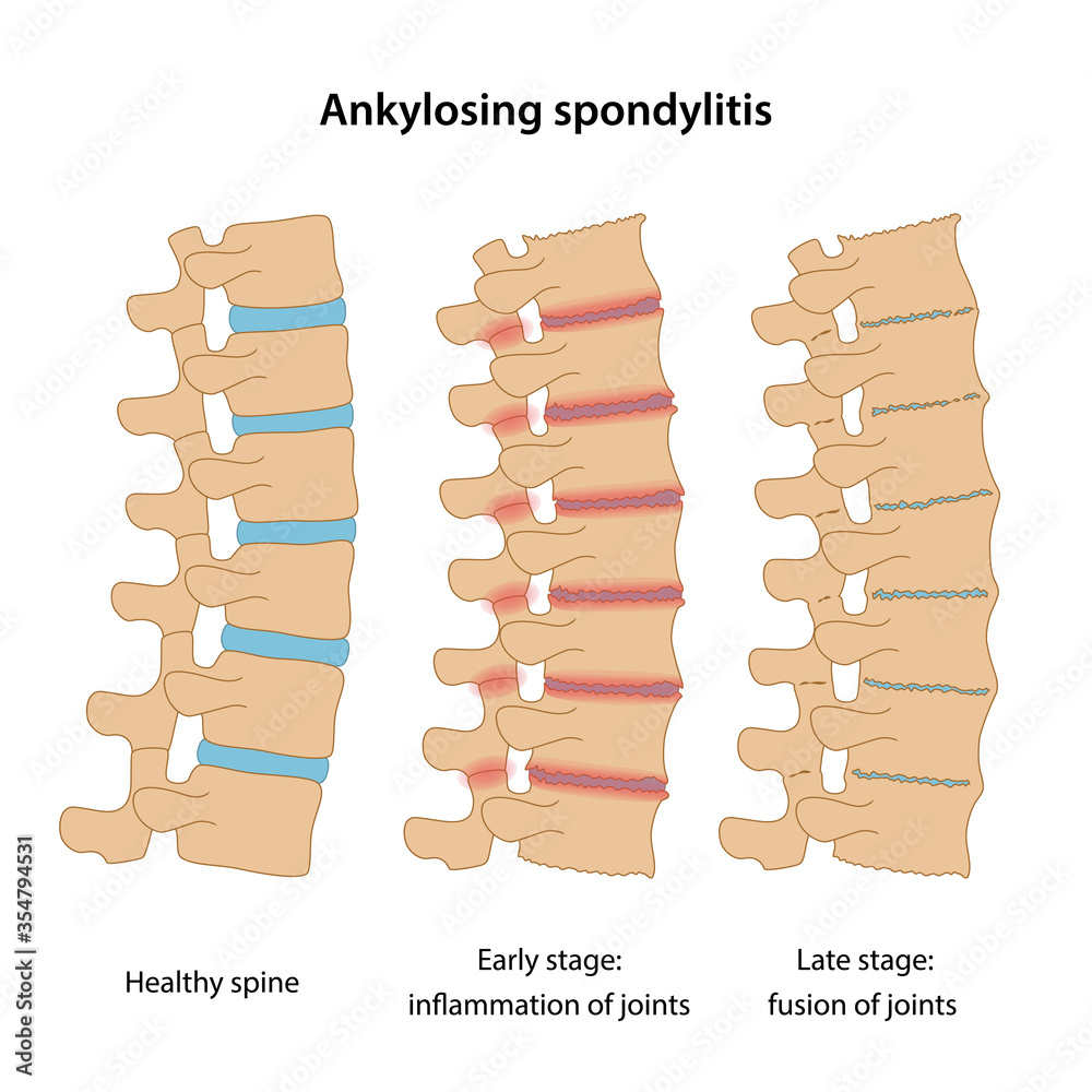 Vecteur Stock Stages of Ankylosing spondylitis healthy disc