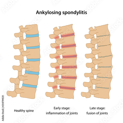 Stages of Ankylosing spondylitis: healthy disc, inflammation of joints and fusion of joints. Medical vector illustration in flat style is isolated on white background photo