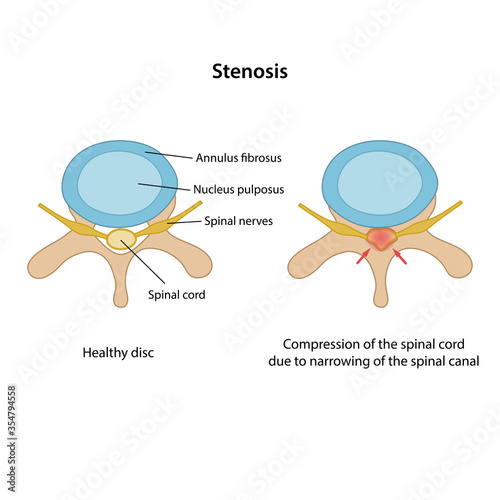 Spinal stenosis with main description. Healthy disc and disc with spinal stenosis in superior view are isolated on white background. Vector illustration in flat style