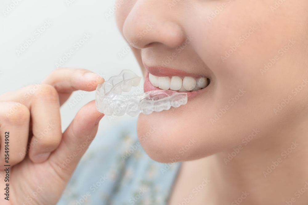 Woman wearing orthodontic silicone trainer. Mobile orthodontic appliance for dental correction. tooth whitening systems. Woman wearing orthodontic silicone trainer. Mobile orthodontic appliance for dental correction. tooth whitening systems.