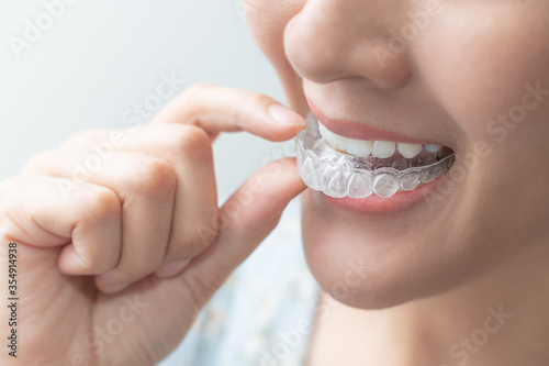 Woman wearing orthodontic silicone trainer. Mobile orthodontic appliance for dental correction. tooth whitening systems.