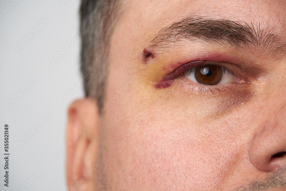 close view of a black eye, man's face with a hematoma