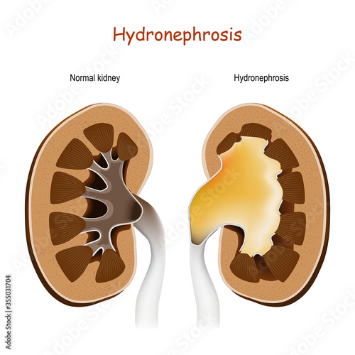 Hydronephrosis. Normal kidney and kidney with disorders.