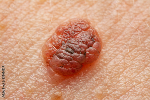 close up of a moles skin