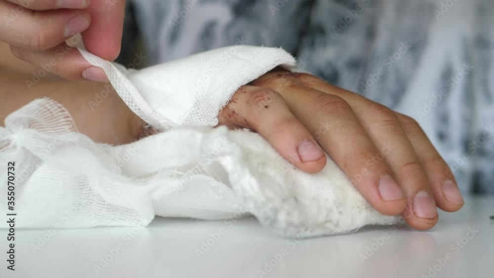 Slow motion shot of injured hand, person taking off bandages, clotted blood. Slow motion shot of injured hand, person taking off bandages, clotted blood.