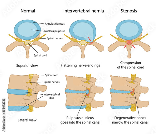 Intervertebral hernia and Spinal stenosis with description. Healthy disc and discs with intervertebral hernia and Spinal stenosis in superior and lateral views. Vector illustration