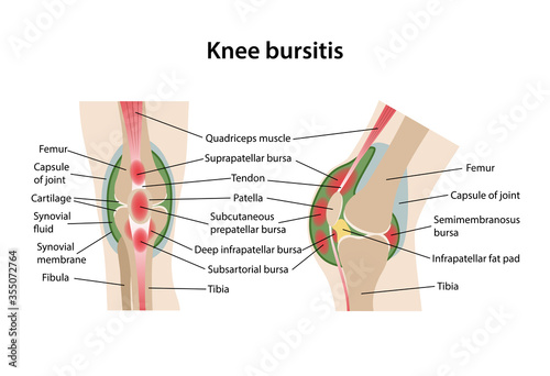 Bursitis of knee joint with main parts labeled. Frontal and sagittal views of bursitis knees. Medical vector illustration in flat style isolated on white background