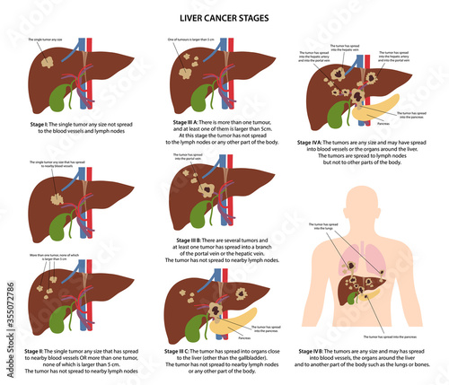 Four stages of liver cancer with description corresponding steps of tumor spread. Medical vector illustration in flat style isolated over white background