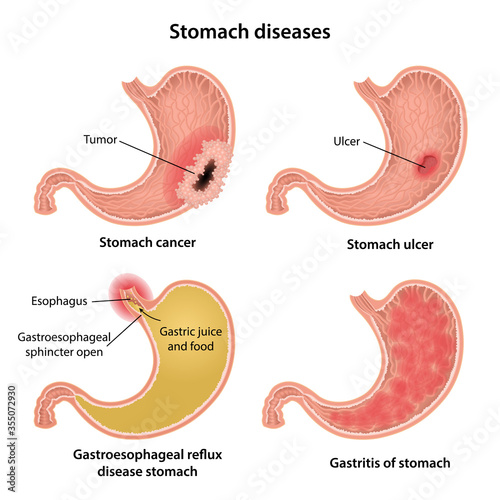 Common stomach diseases. Cancer, ulcer, gastritis and gastroesophageal reflux disease of the stomach isolated over white background. Anatomical vector illustration.
