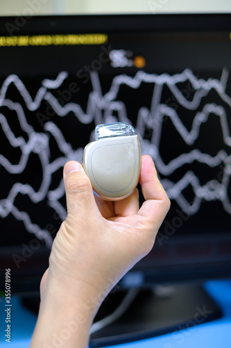 This image demonstrates Implantable cardioverter defibrillator (ICDs) on hands photo