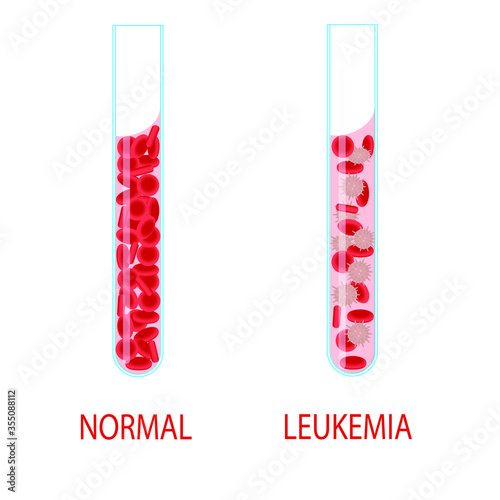 Leukemia. Vector illustration of normal blood and blood of a patient with leukemia in laboratory test tubes. Leukemia concept. Vector stock isolated image on a white background.