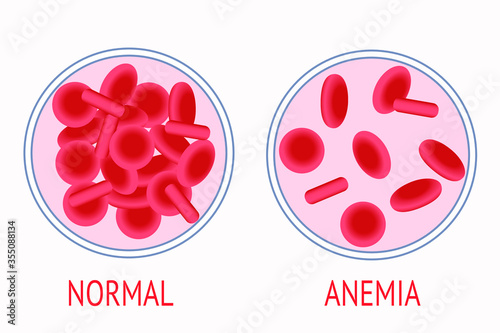 Anemia. Vector illustration of normal blood and blood of a patient with anemia in laboratory test tubes. Leukemia concept. Vector stock isolated image on a white background.