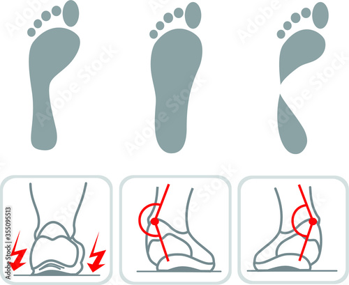 type of footprint icons type of pronation photo