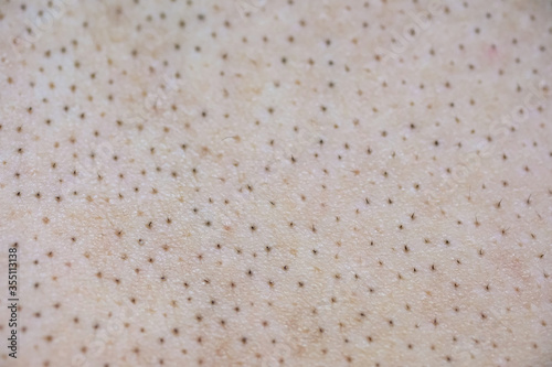 Skin with large pores and acne blackhead problems.