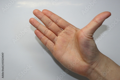 Demonstration of hypermobility of a thumb in open palm position. photo