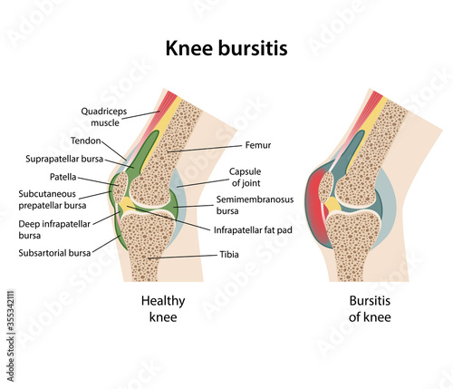 Bursitis of the knee joint with main parts labeled. Sagittal views of a healthy knee joint and bursitis of knee. Vector illustration are isolated on a white background