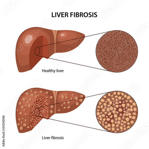 Liver fibrosis. Histology of the healthy and fibrous liver with corresponding labels. Anatomical vector illustration in flat style isolated over white background.