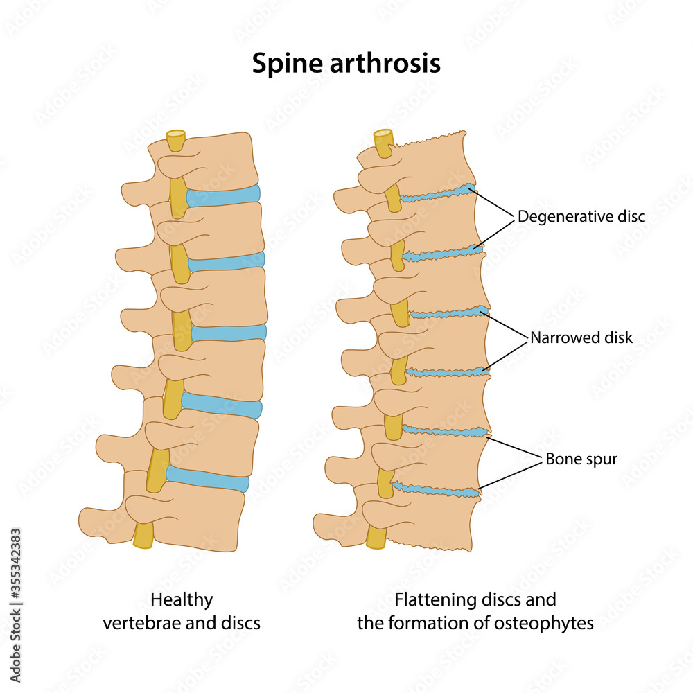 Spine arthrosis with main description. Healthy spine and spine with ...