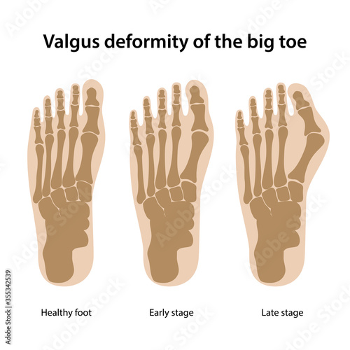 Valgus deformity of the big toe. Healthy foot and stages of development of the disease. From above view. Vector illustration in flat style on white background