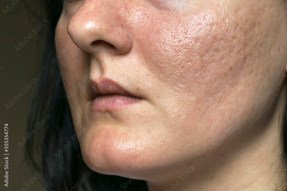 Woman with problematic skin and acne scars. Pigmentation on face woman. Problem skin care and health concept. Woman with problematic skin and acne scars. Pigmentation on face woman. Problem skin care and health concept.