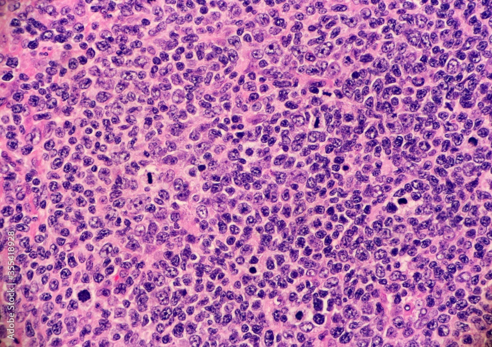 Obraz premium High grade follicular lymphoma with marginal zone differentiation. Multiple lymphocytes are undergoing mitosis. Microscopic view.