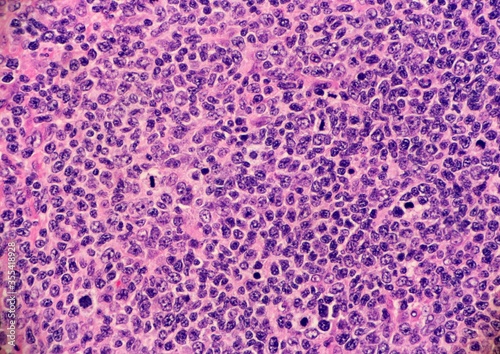 High grade follicular lymphoma with marginal zone differentiation. Multiple lymphocytes are undergoing mitosis. Microscopic view. photo